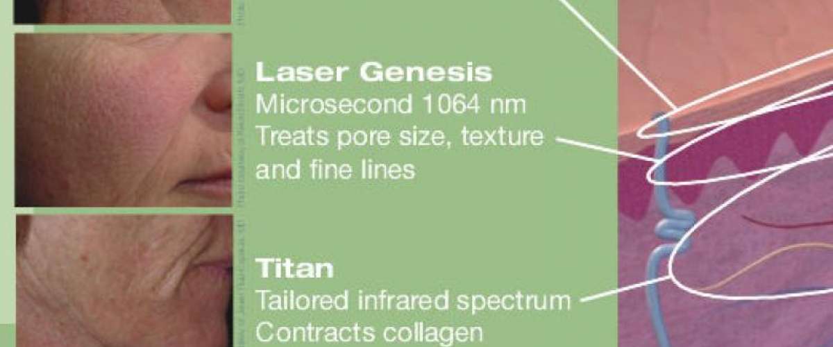 Laser Genesis(3D)