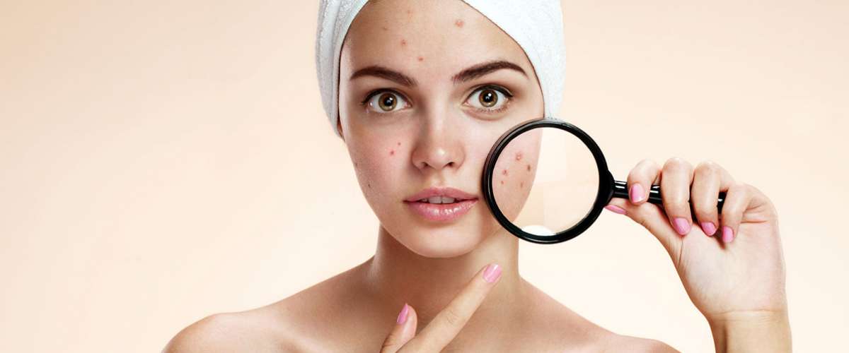 I Clear XL for Acne Reduction