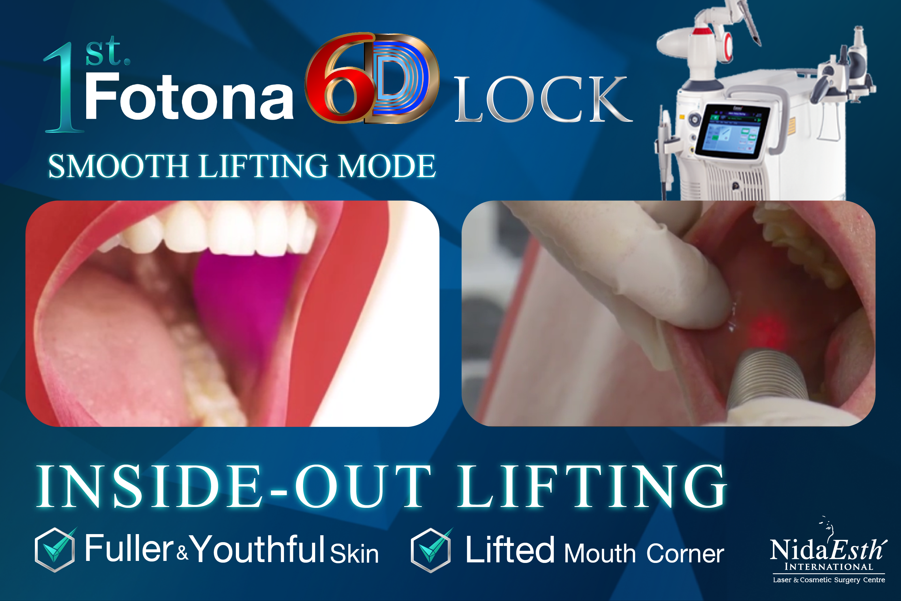 1st Lock: SmoothLifting Mode by Fotona 6D