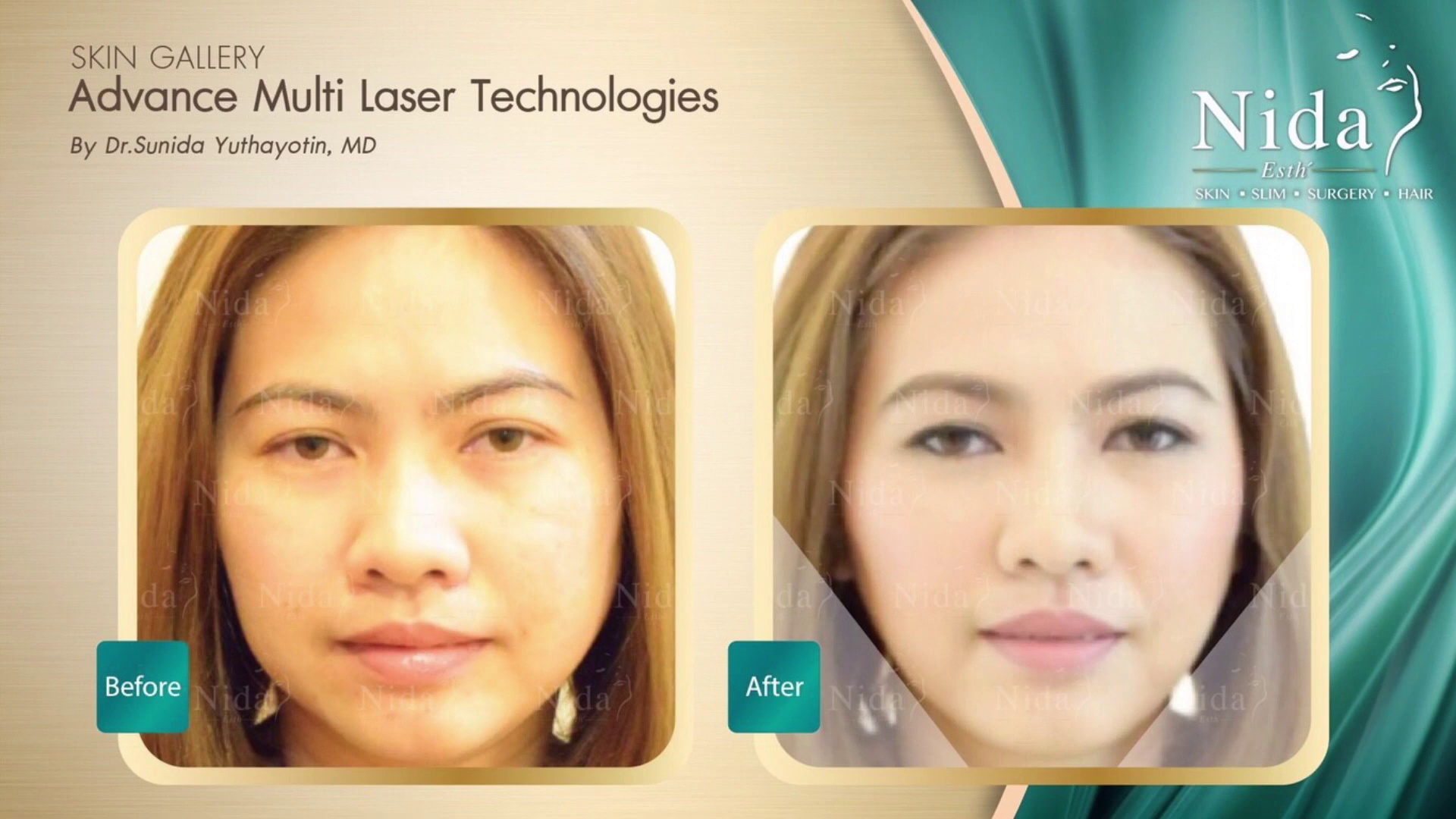 Before - After Deep Lock Gold Laser