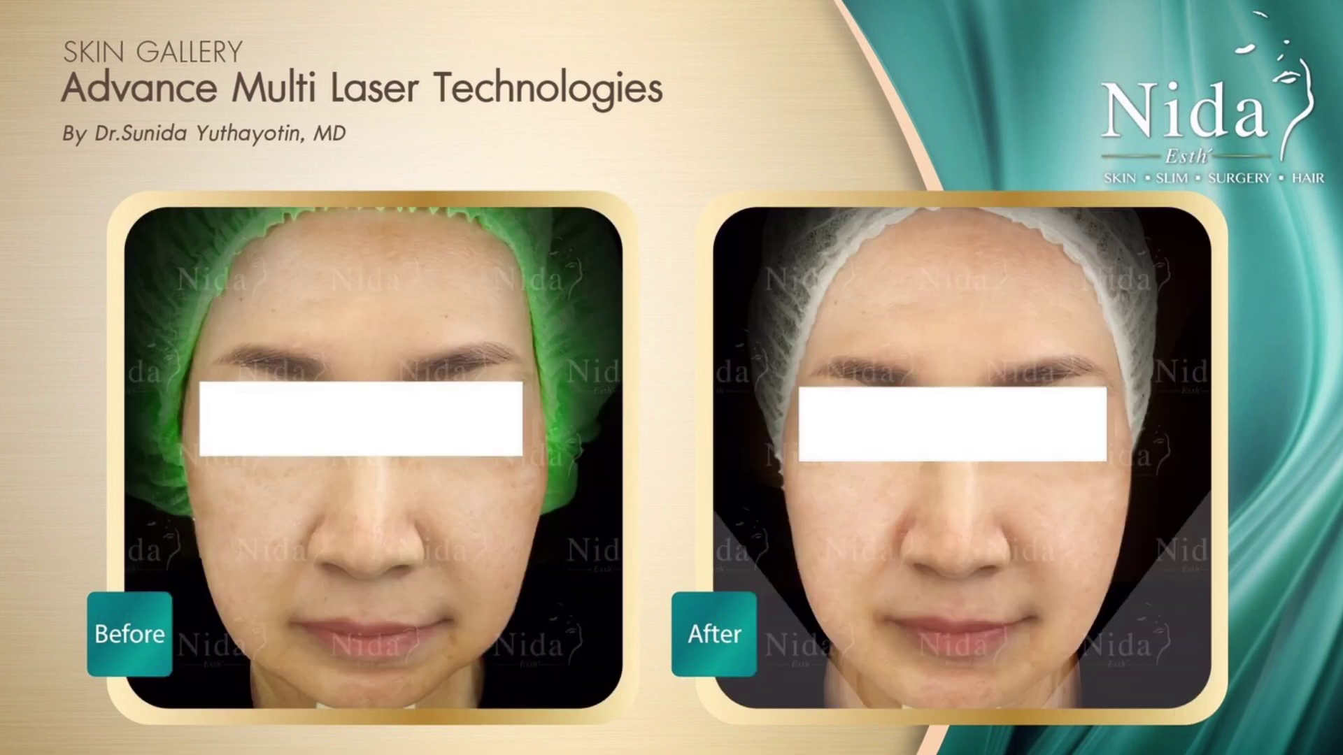 Before - After Deep Lock Gold Laser