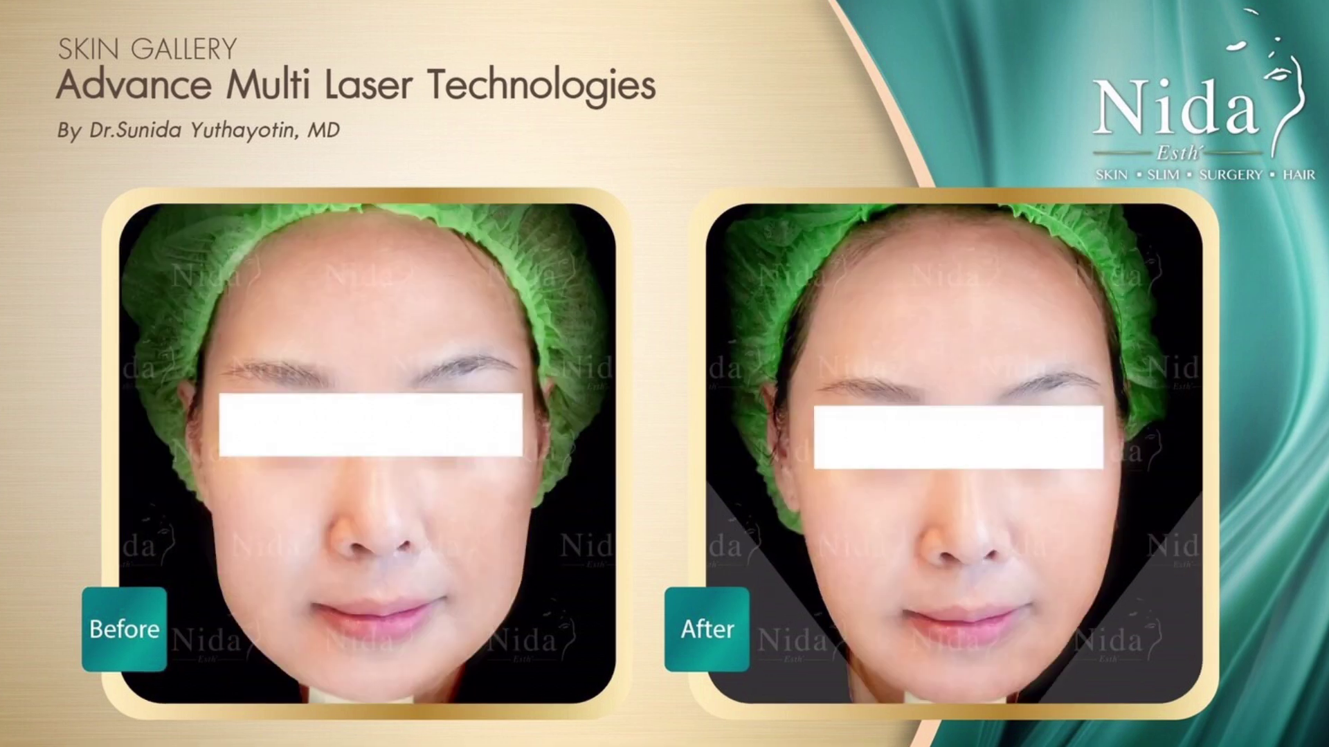 Before - After Deep Lock Gold Laser