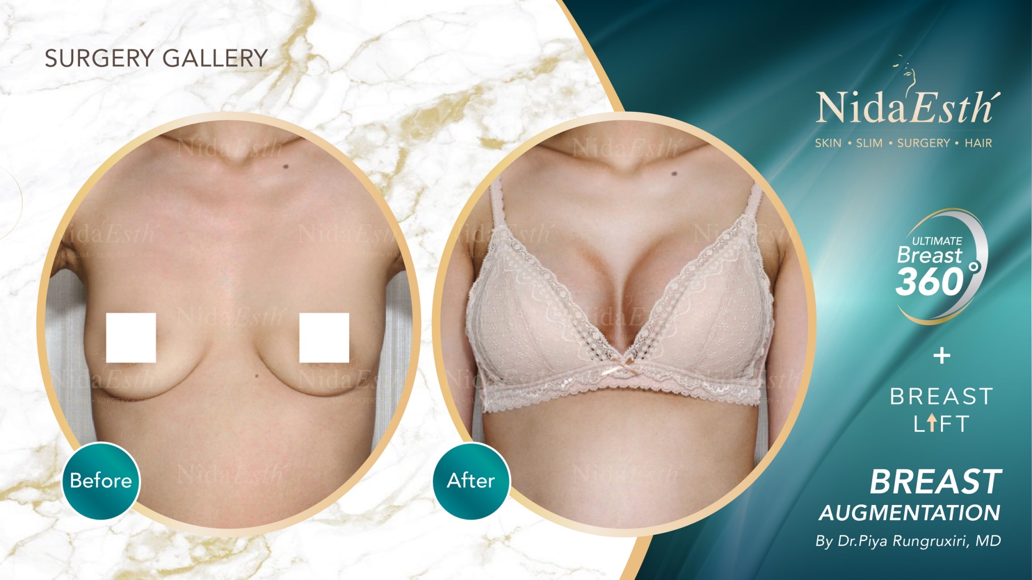 Before - After Ultimate Breast 360 °