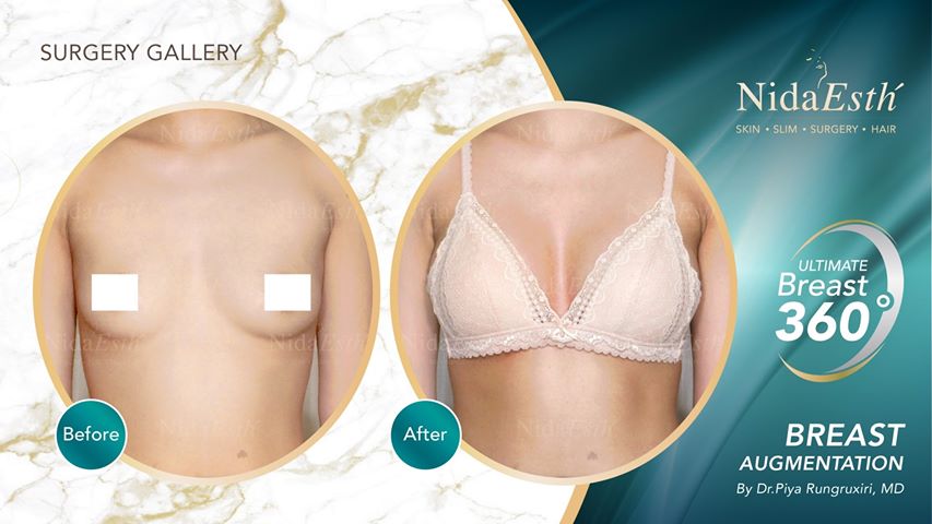 Before - After Ultimate Breast 360 °