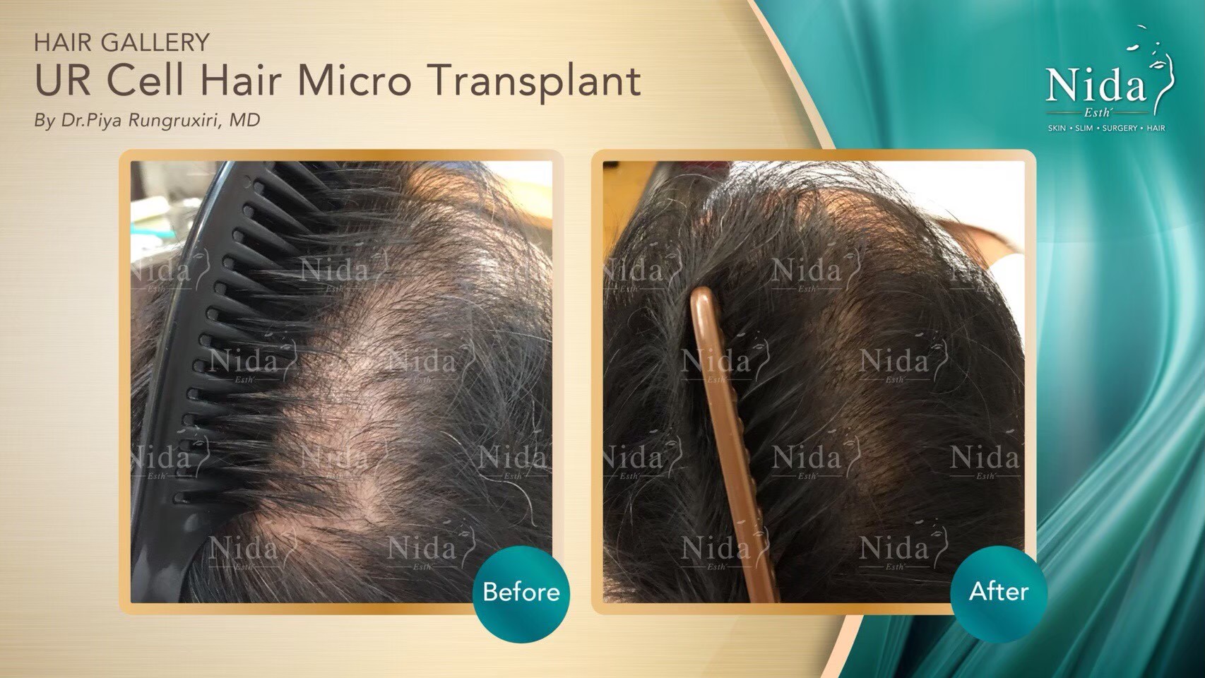 Before - After Ur cell Hair Micro Transplant