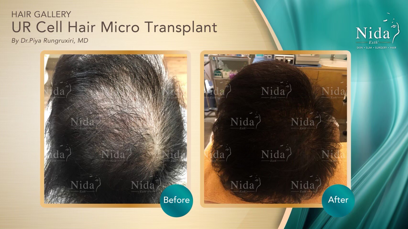 Before - After Ur cell Hair Micro Transplant