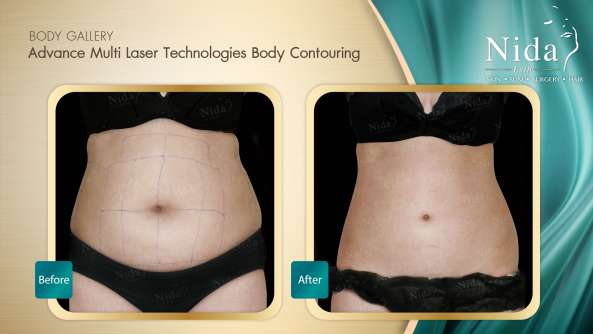 Body Contouring