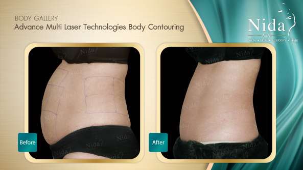 Body Contouring