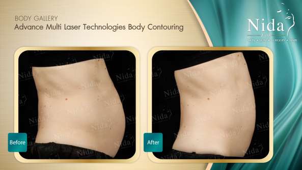 Body Contouring