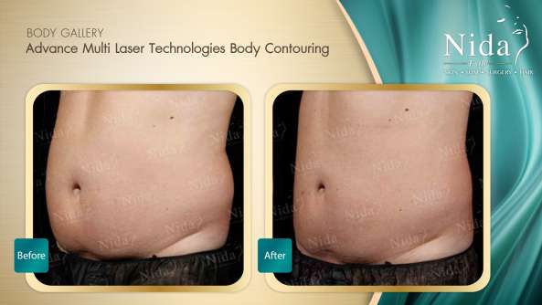 Body Contouring