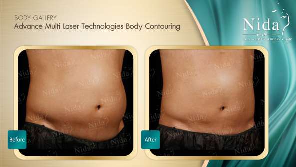 Body Contouring