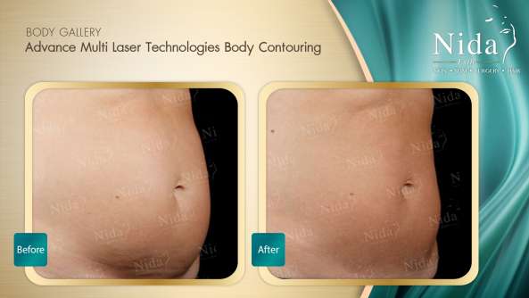 Body Contouring