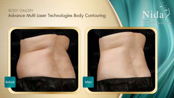 Body Contouring