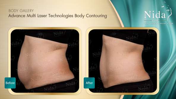 Body Contouring