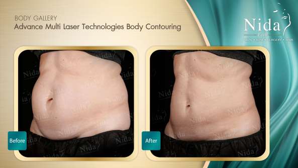 Body Contouring