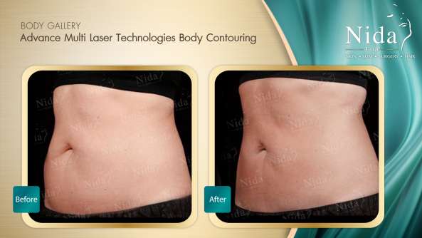 Body Contouring