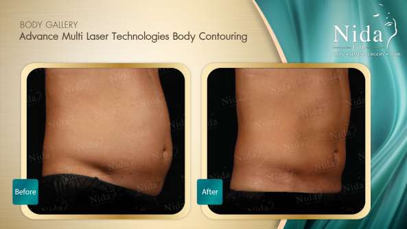 Body Contouring