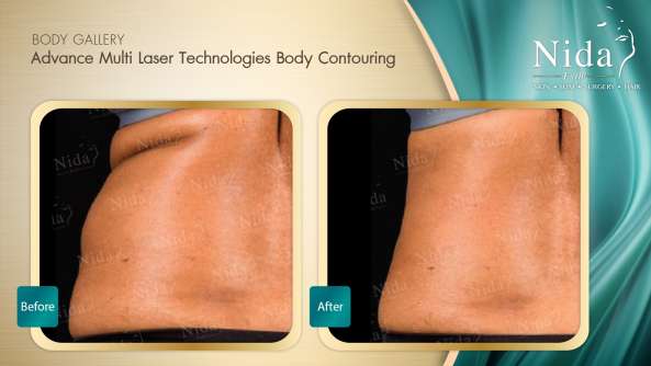 Body Contouring