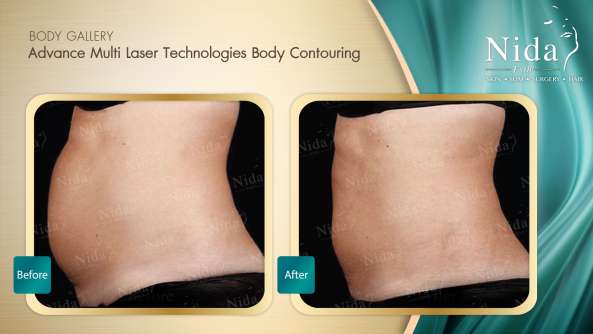 Body Contouring