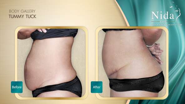 Tummy Tuck