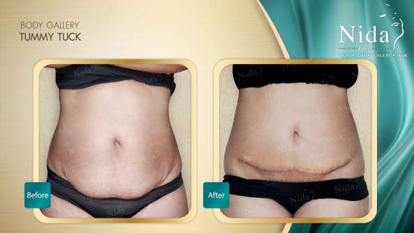 Tummy Tuck