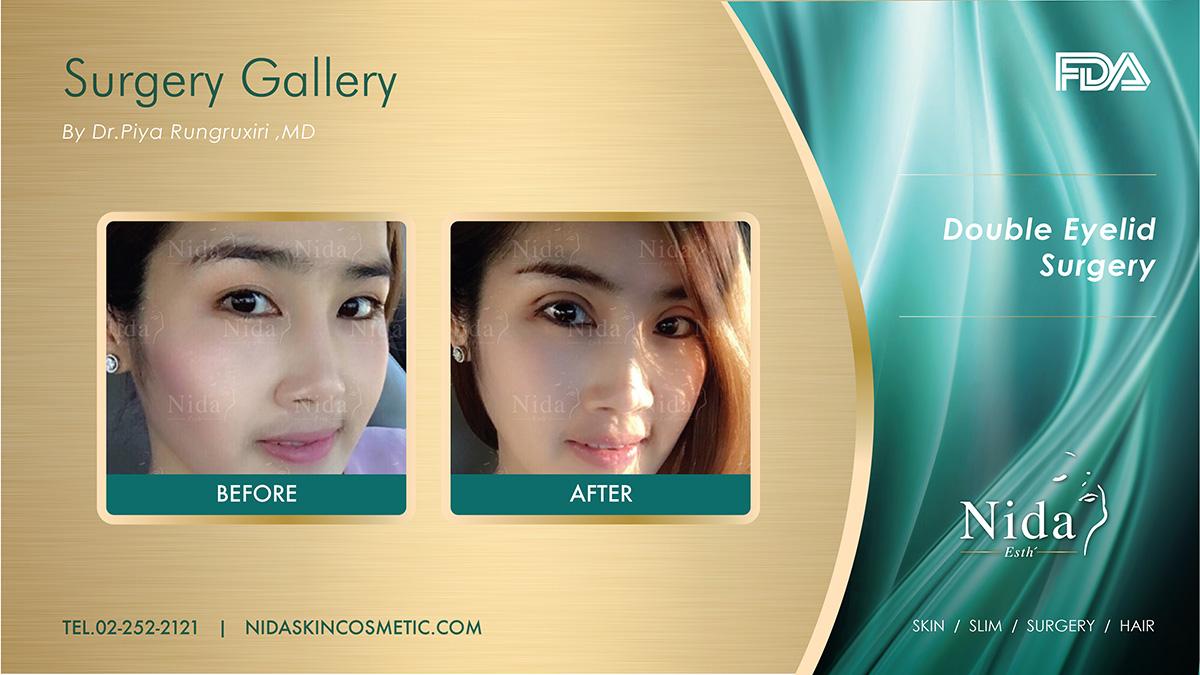 Double Eyelid Surgery