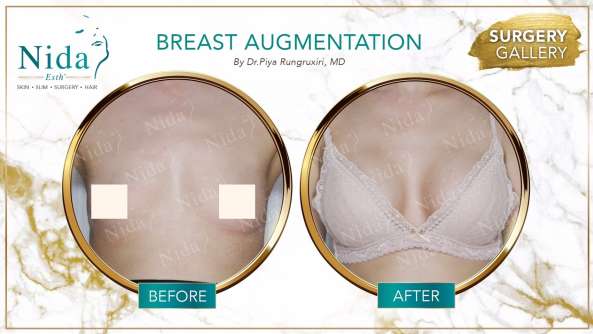 Breast Augmentation