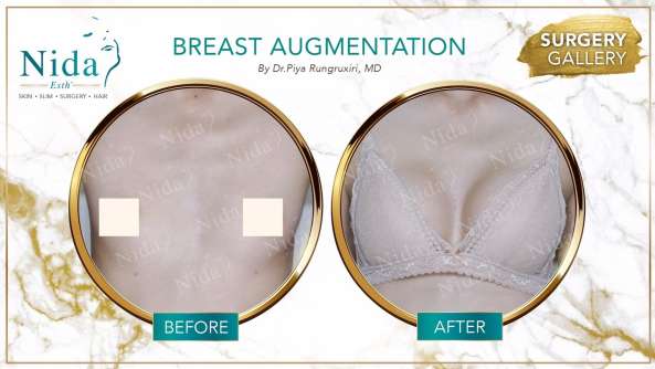 Breast Augmentation