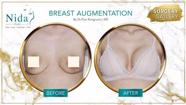 Breast Augmentation