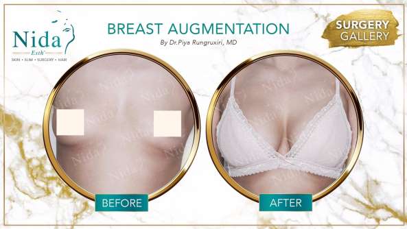 Breast Augmentation