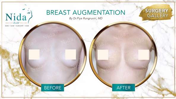 Breast Augmentation