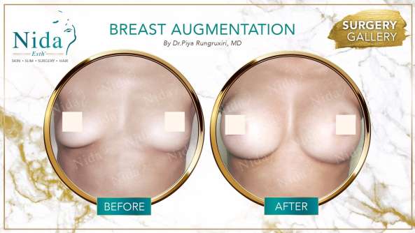 Breast Augmentation