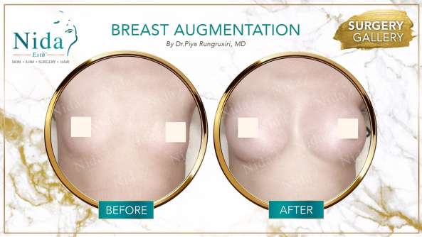 Breast Augmentation