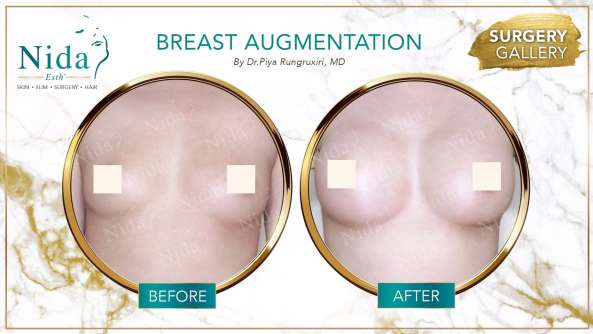 Breast Augmentation