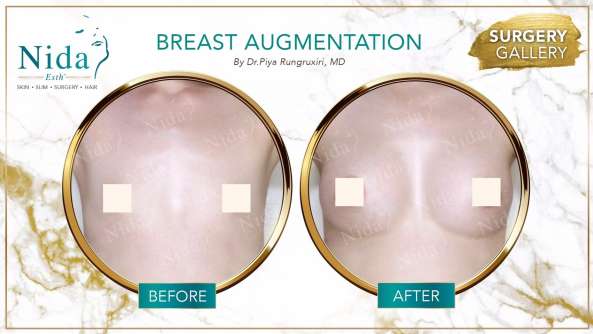 Breast Augmentation