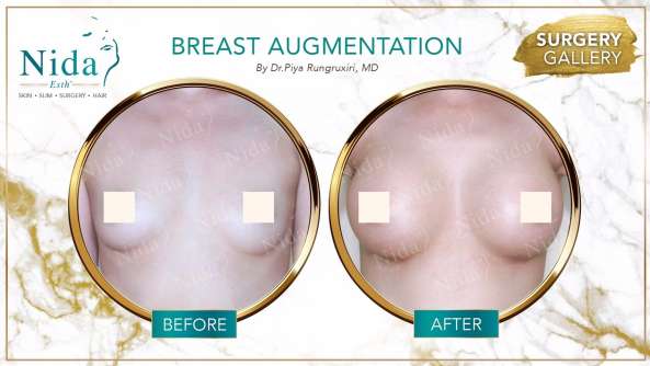 Breast Augmentation