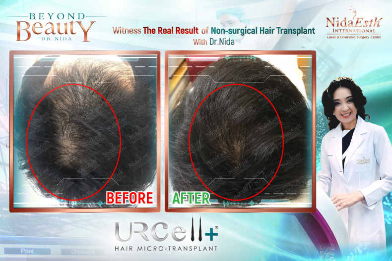 Stem cell based hair transplant for more natural, healthier & thicker hair