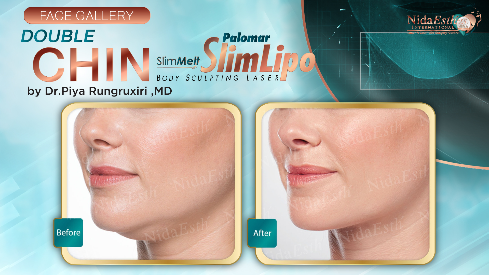 Double Chin Liposuction by Slim Melt