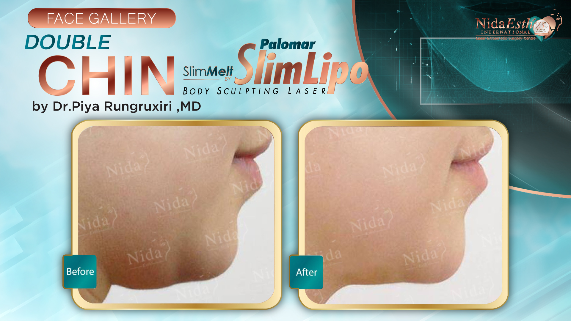 Double Chin Liposuction by Slim Melt