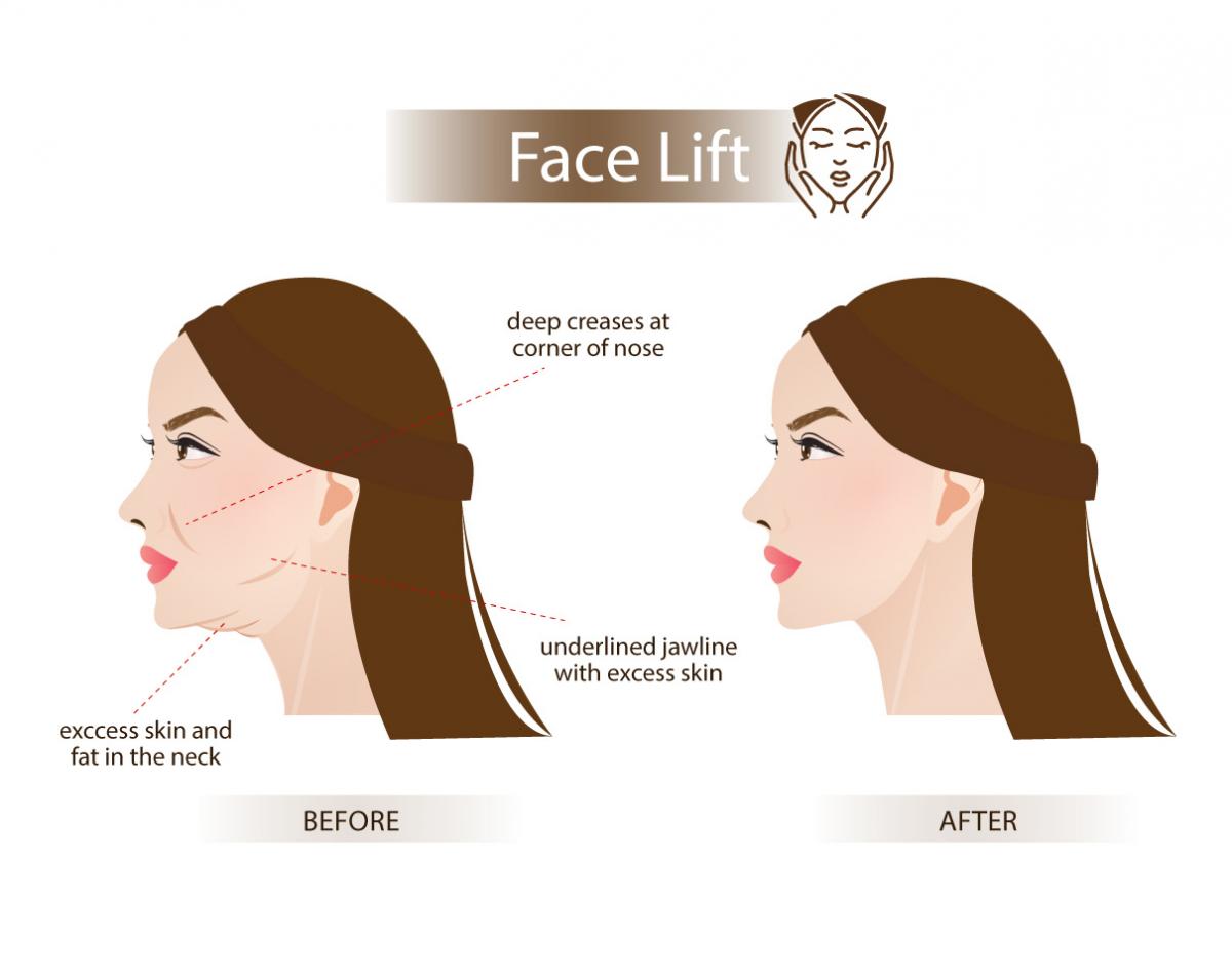 full-face-lift