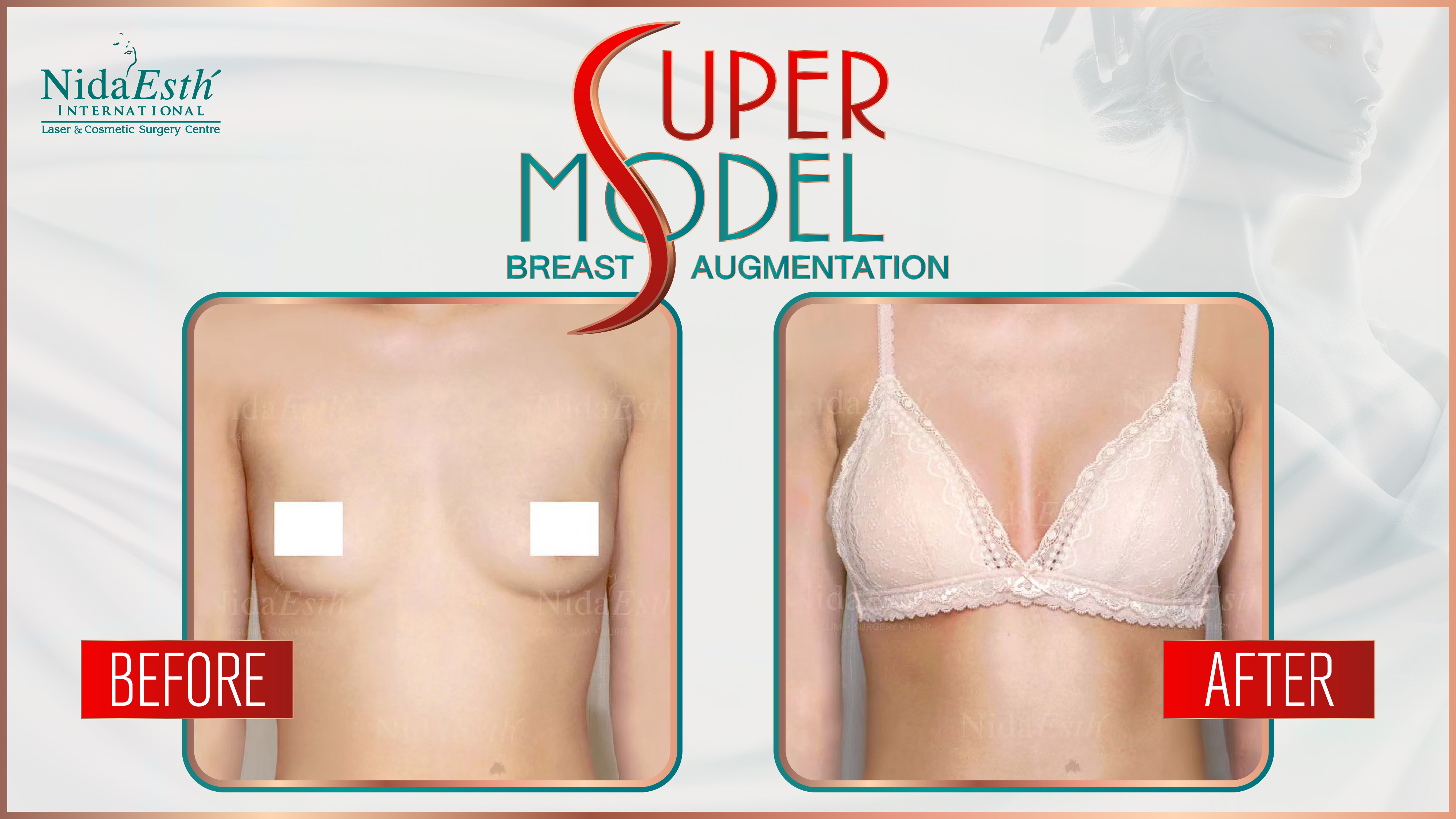 BA Super Model Breast Augmentation