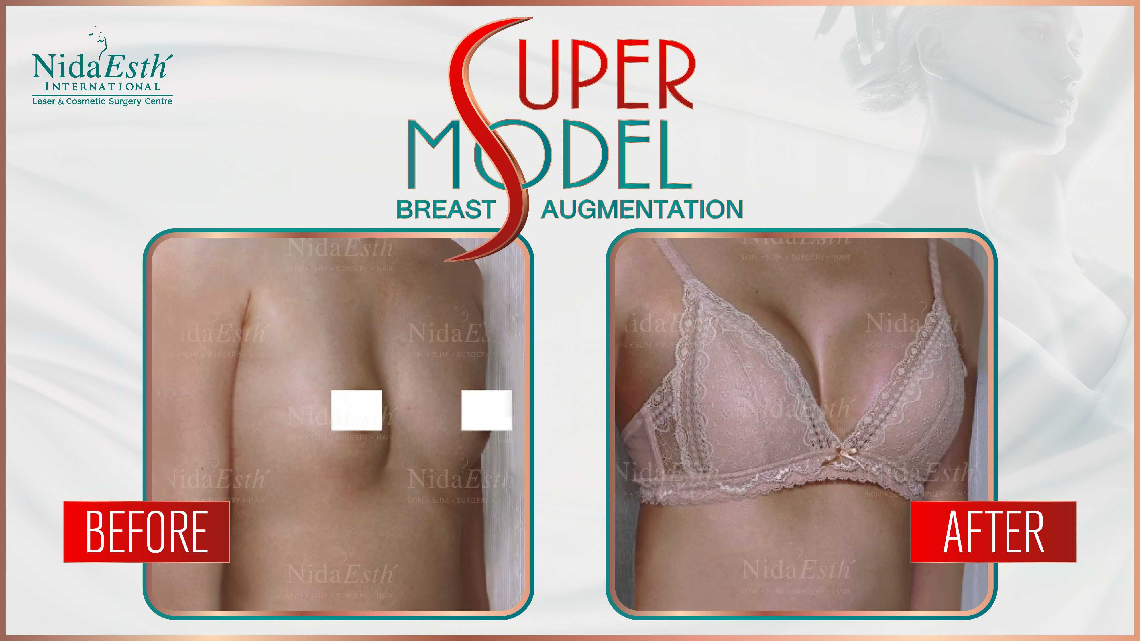 BA Super Model Breast Augmentation