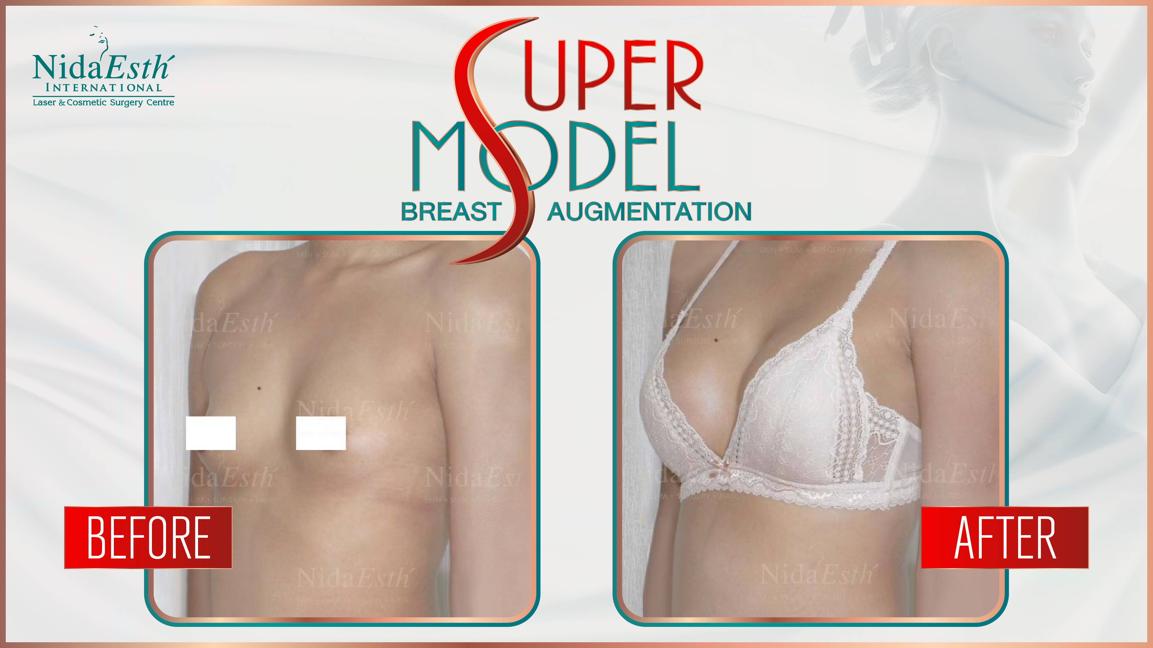 BA Super Model Breast Augmentation