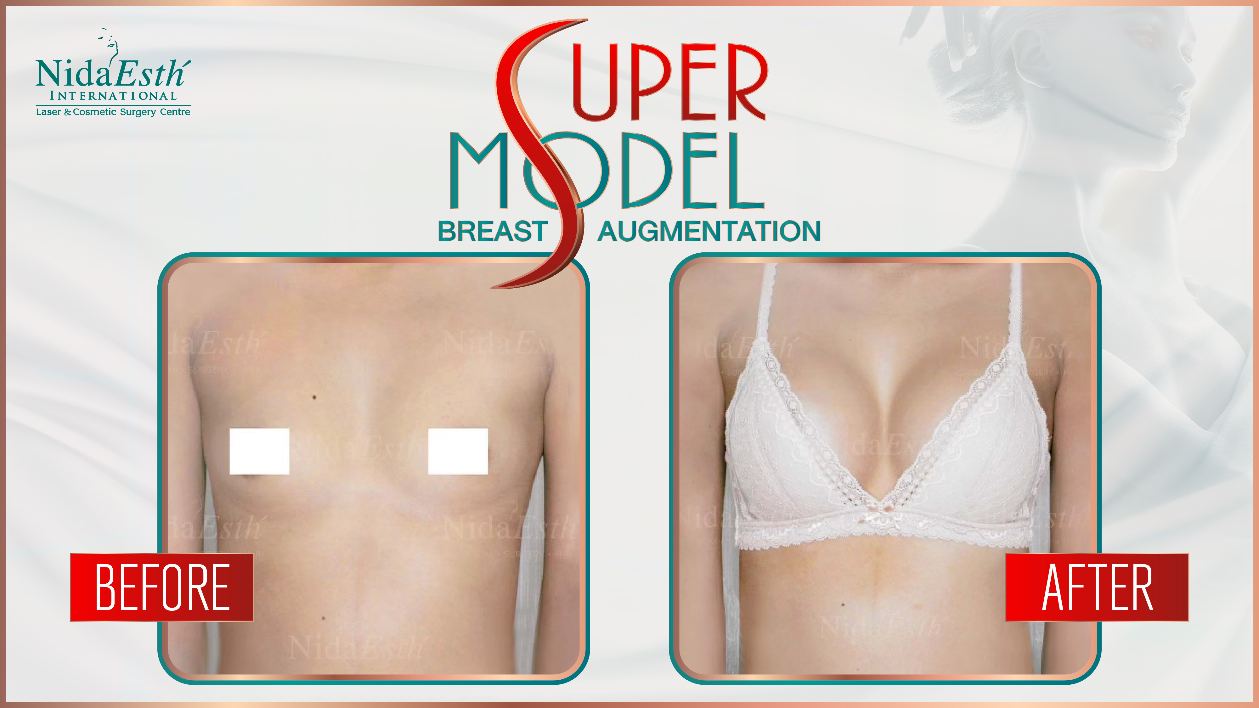 BA Super Model Breast Augmentation