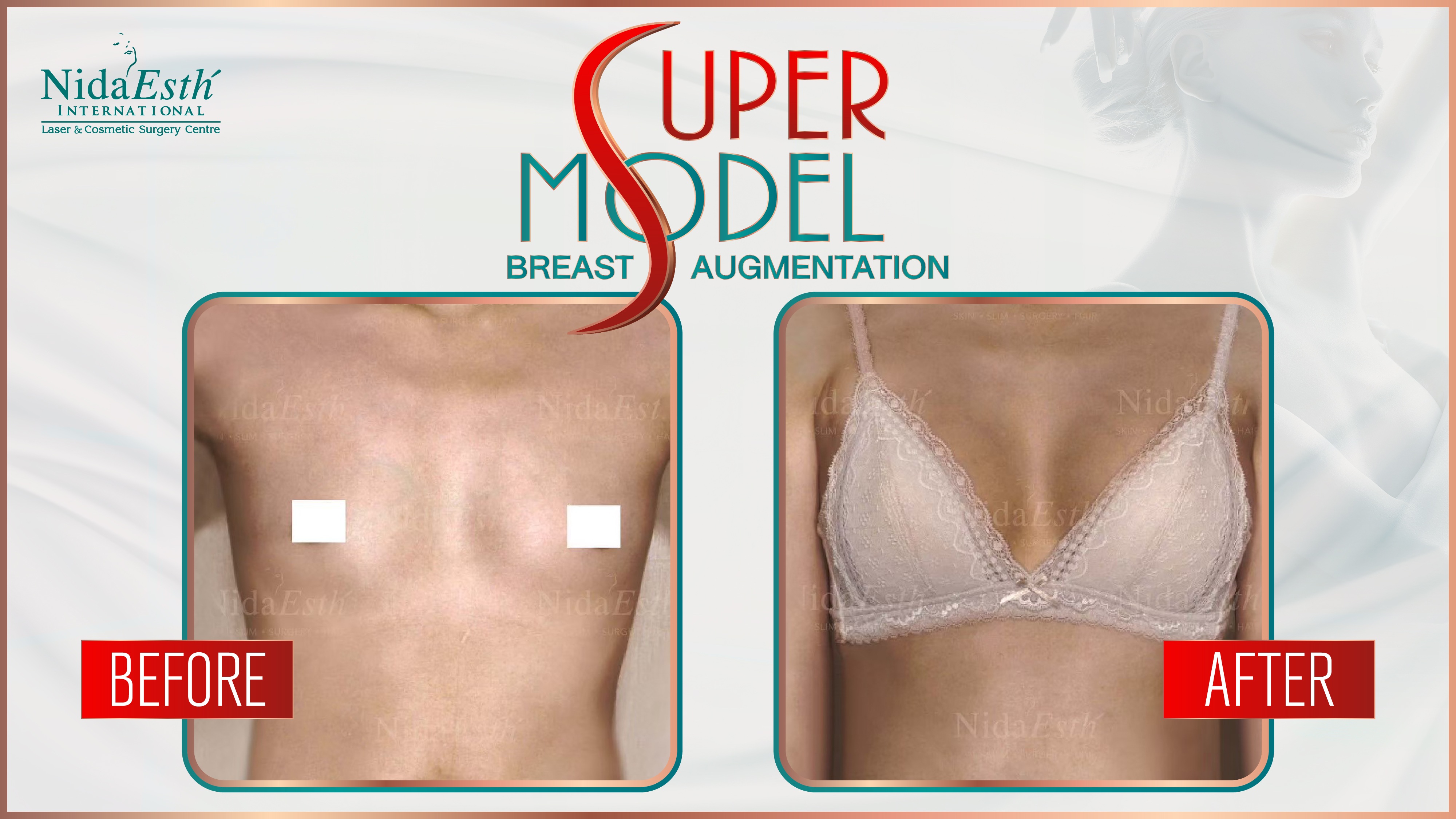 BA Super Model Breast Augmentation