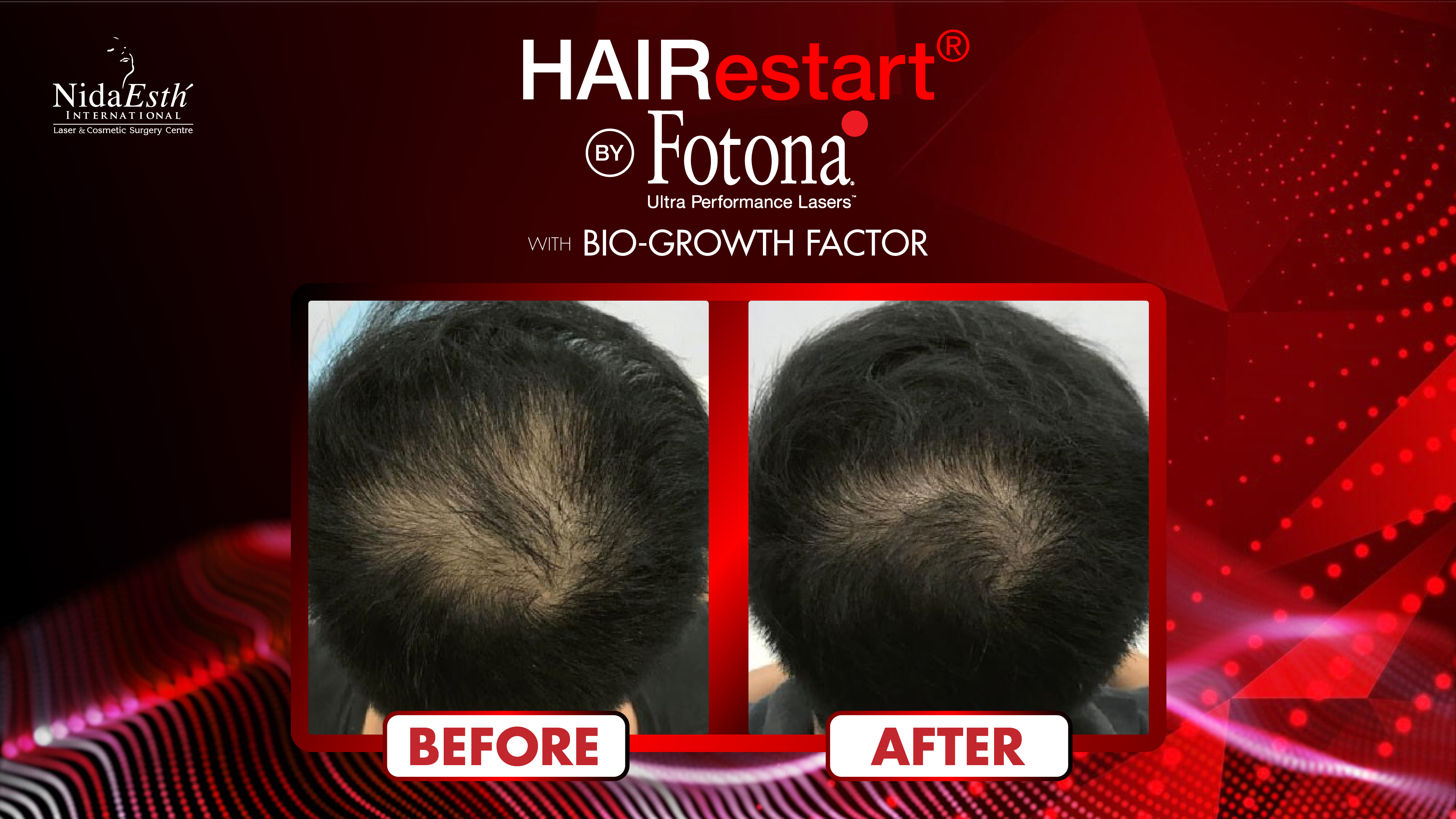 Hair Restart by Fotona