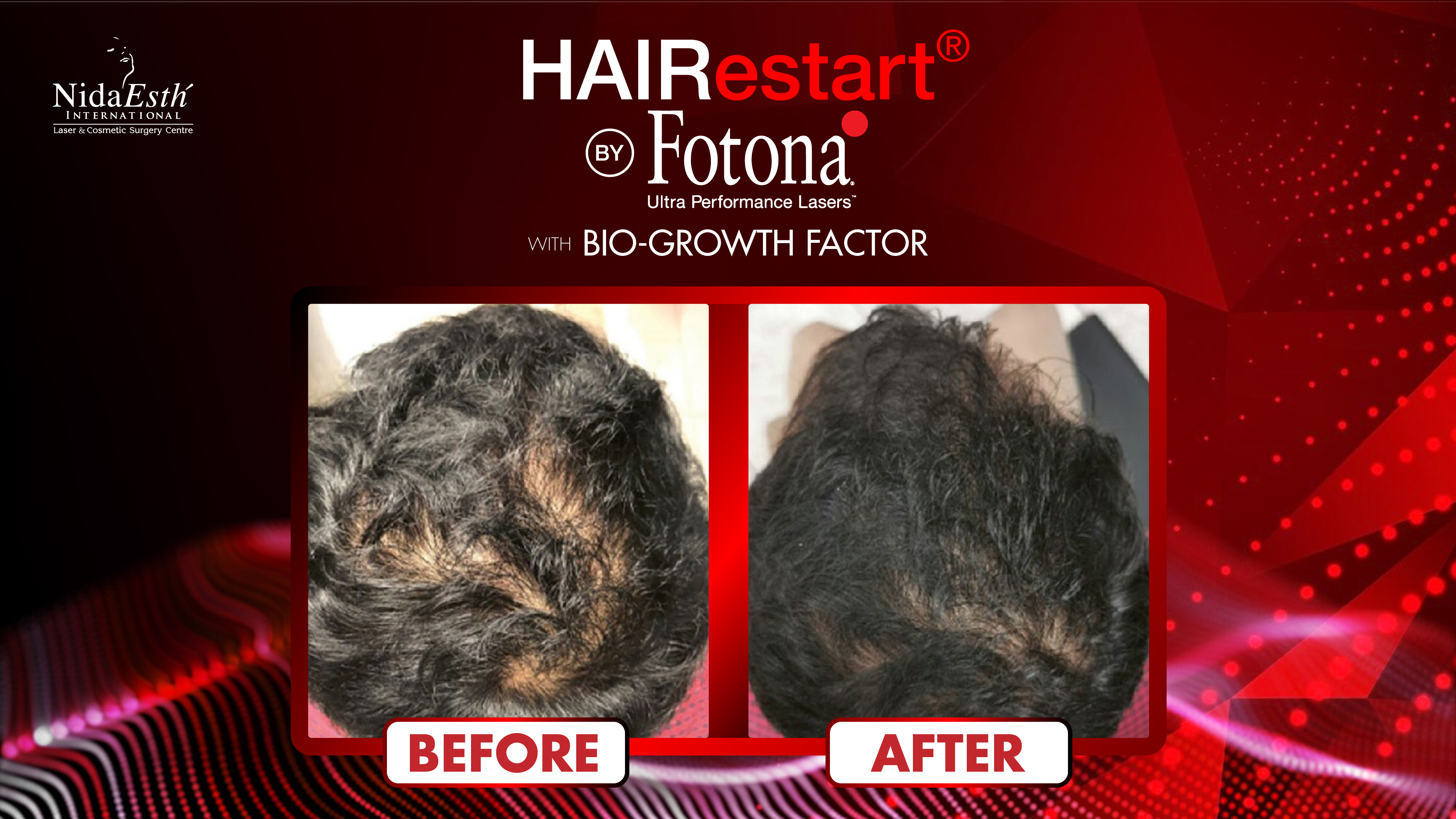 Hair Restart by Fotona