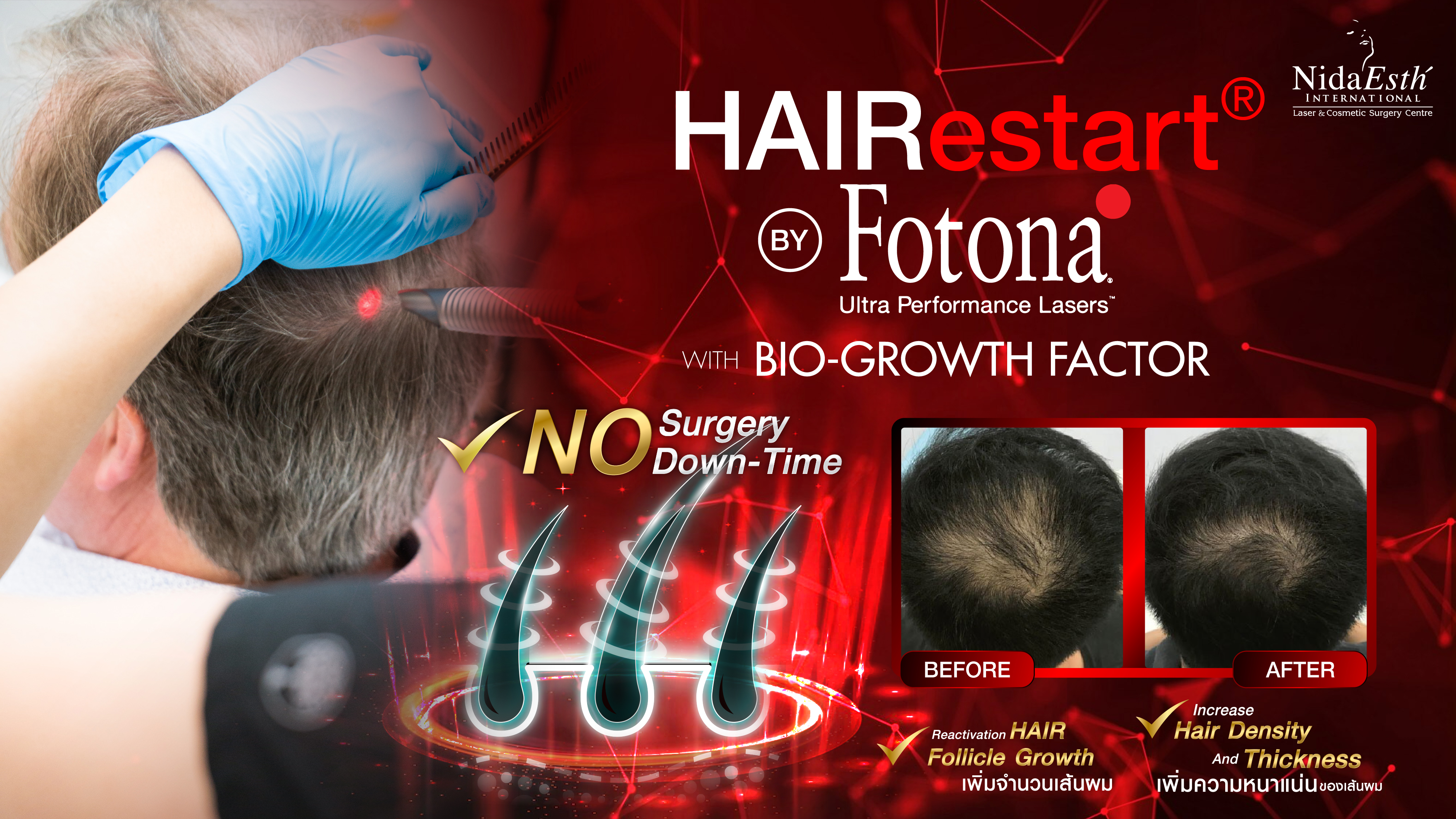 Hair Restart by Fotona