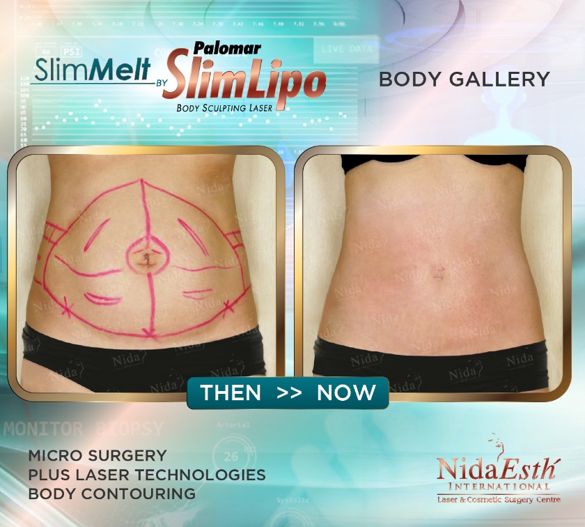 liposuction-slim-bkk-1