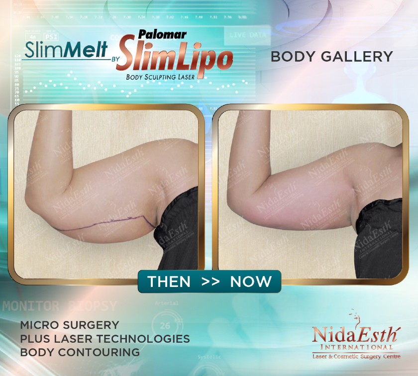 liposuction-slim-bkk-2